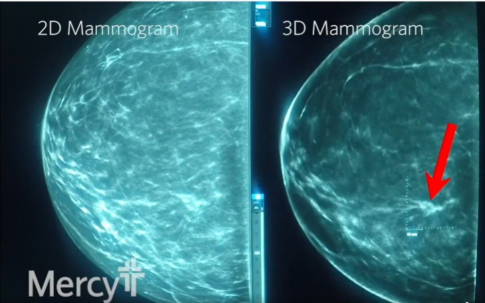 It's difficult to overstate how much more advanced a 3D mammogram is than the traditional 2D imaging. Clearer reads mean earlier detection, and everyone knows how critical that is in cancer care. Click here to learn more and schedule your 3D mammogram: ow.ly/ZAjX50UtvGg