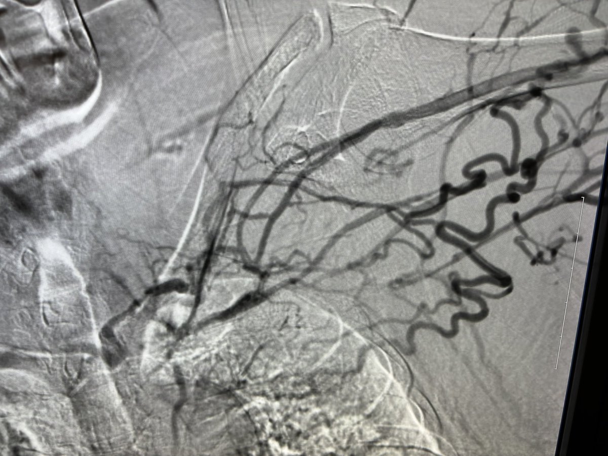 RepkoMd's tweet photo. Common Ulnar Artery to Lat Ulnar Vein @endoavf @wavelinq LUE fistula in elderly female with limited veins. Swelling and pain in arm 2 weeks after creation. No Contralateral AVF or AVG options.
Thoughts:
1. Close fistula. TDC for life.
2. Try to make it work. https://t.co/lDEy8AFAyp