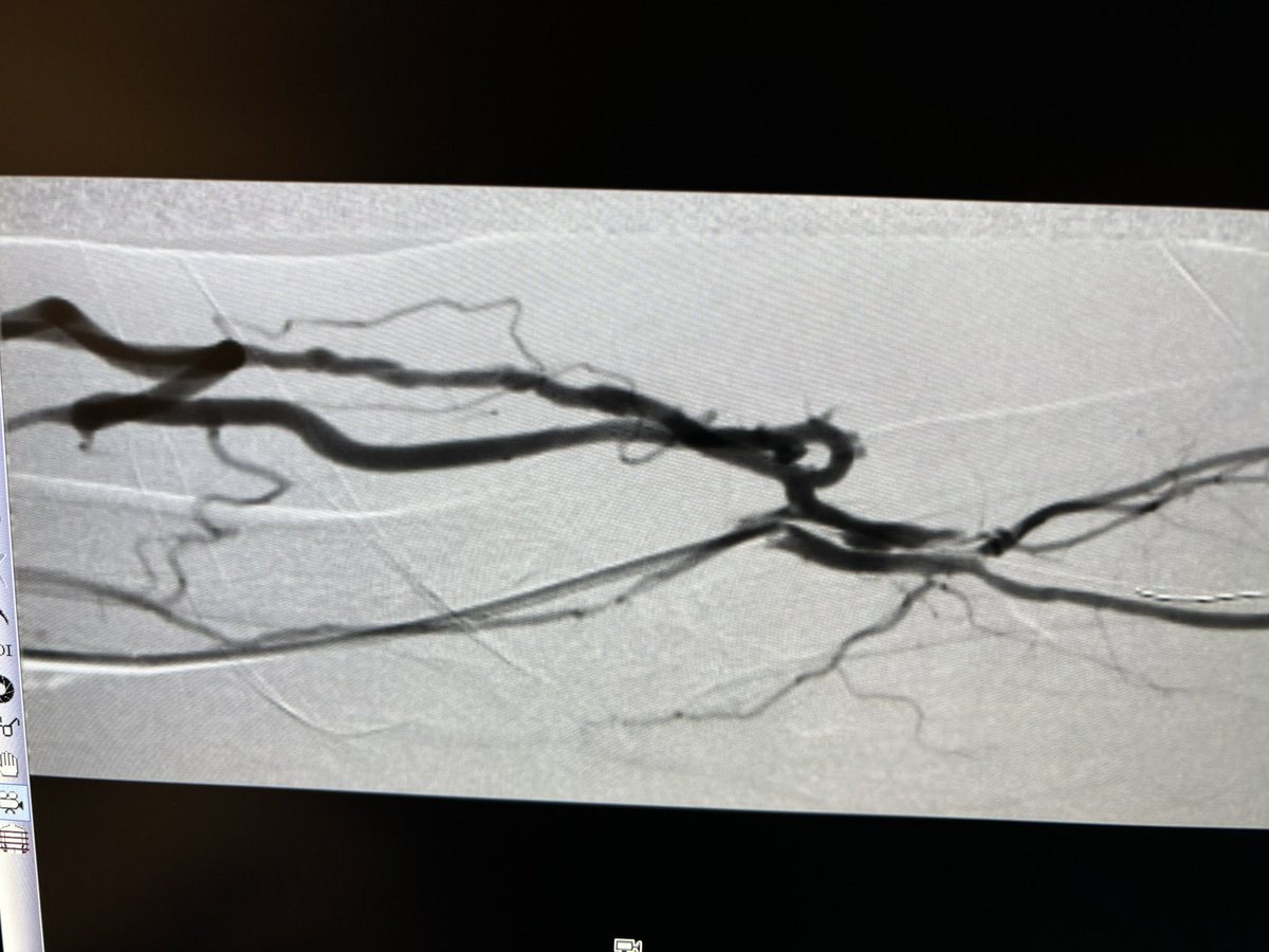 RepkoMd's tweet photo. Common Ulnar Artery to Lat Ulnar Vein @endoavf @wavelinq LUE fistula in elderly female with limited veins. Swelling and pain in arm 2 weeks after creation. No Contralateral AVF or AVG options.
Thoughts:
1. Close fistula. TDC for life.
2. Try to make it work. https://t.co/lDEy8AFAyp