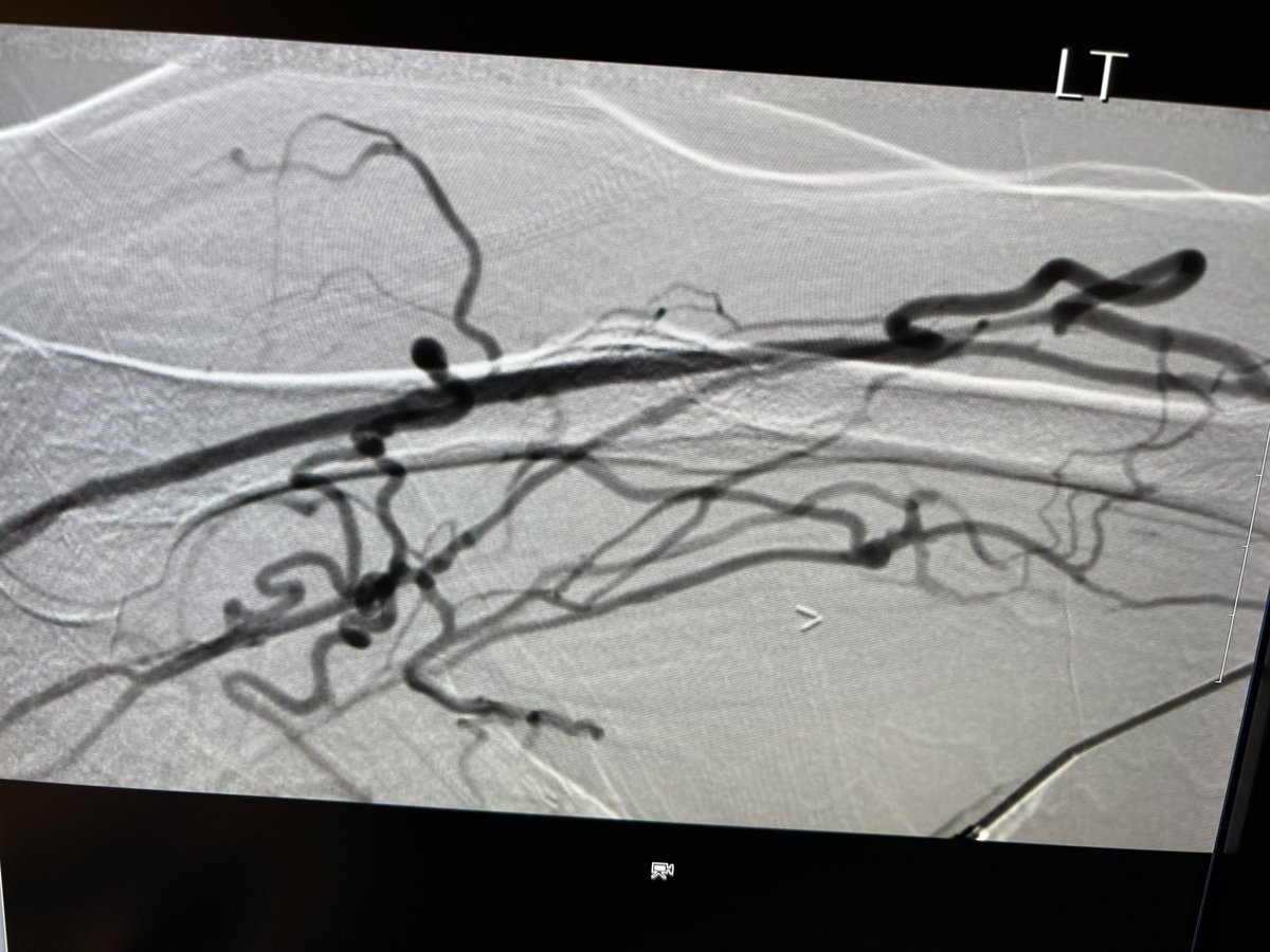 RepkoMd's tweet photo. Common Ulnar Artery to Lat Ulnar Vein @endoavf @wavelinq LUE fistula in elderly female with limited veins. Swelling and pain in arm 2 weeks after creation. No Contralateral AVF or AVG options.
Thoughts:
1. Close fistula. TDC for life.
2. Try to make it work. https://t.co/lDEy8AFAyp