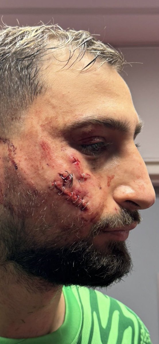 tancredipalmeri's tweet image. Donnarumma sfregiato dopo il colpo al volto 

(via @RMCsport )