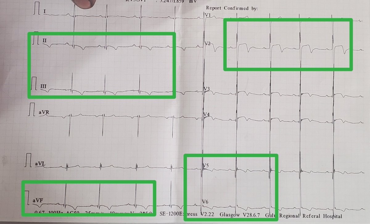 DrRazi4's tweet photo. @DrJNELLY95 @IBBI_2501 @ManualOMedicine @MakCHS_SOM @InternalmedMak @lacor_hospital @EmMakerere @NsambyaHospital @ZHeart11768530 @American_Heart @smithECGBlog @Ecgloverr @NIH @DrOribaDan @ecgandrhythmRoe @ECGcases @EM_RESUS @walinjom @RobertHermanMD @Interve15538505 @DrAkhilX @healthefyheart #ecgs shows:
1. Pseudo Wallen pattern of LVH in V2-V4
2. STD with TWi inferolateral leads - repolarization abnormality due to LVH a.k.a strain pattern
🔺LVH #ecg https://t.co/h3K9qRx4rf