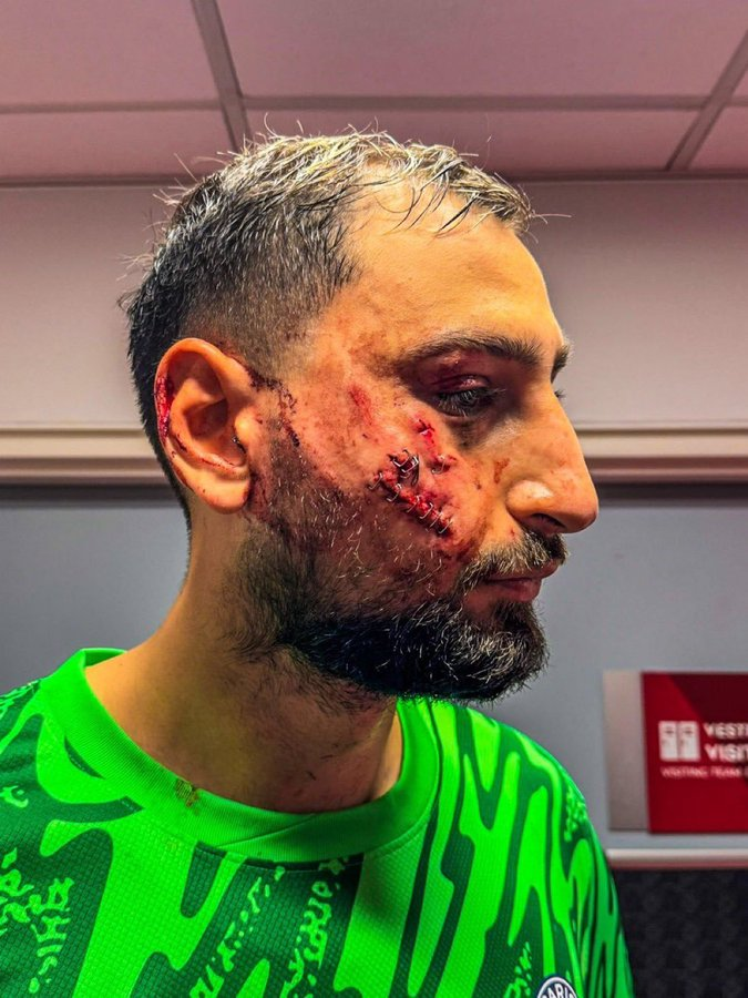 onedio's tweet photo. Monaco-PSG maçında Wilfried Singo'nun Donnarumma'ya yaptığı darbe sonucu yüzüne dikiş atılan Donnarumma, oyuna devam edemedi. https://t.co/Os0McdyQPQ