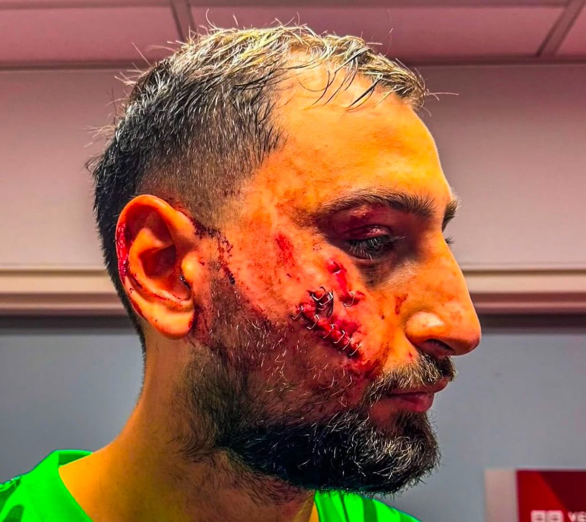Donnarumma after getting a cleat to the face 😳
