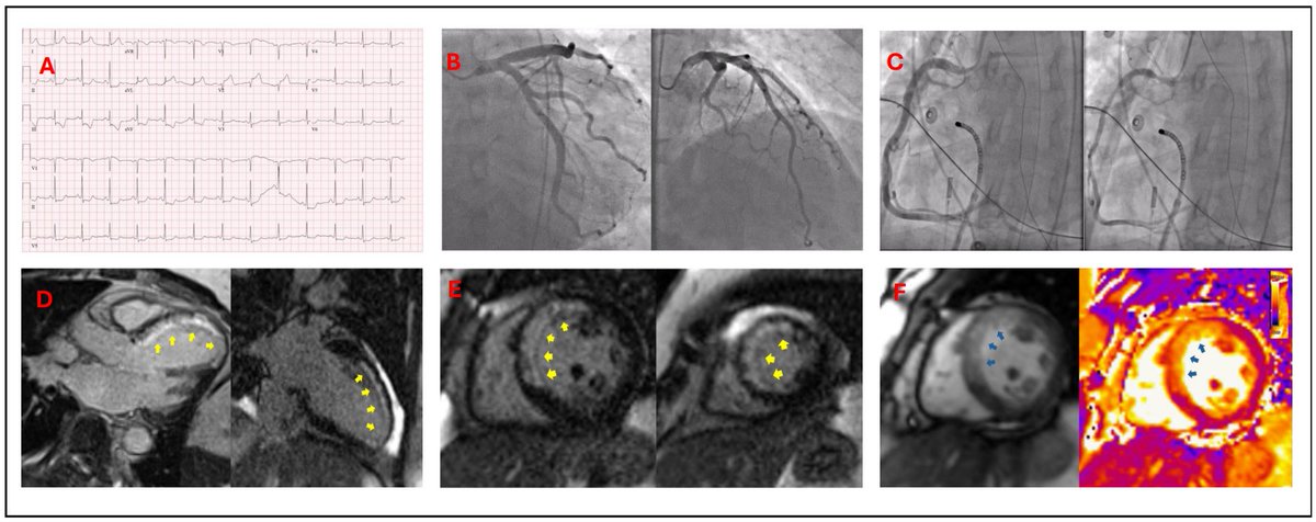 CircImaging's tweet photo. Chest pain is the most common presentation of myocardial infarction in females. We present a case of vasospastic angina with an unusual treatment pathway that proved successful @chamsipash @HMethodistCV #AHAJournals @JiwonKimMD @kaznegishi
https://t.co/GFhuxDcK9P https://t.co/fVaWnzfRoj