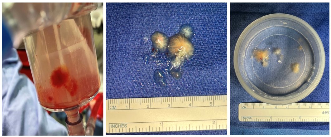Abdallah El Sabbagh (@aelsab) on Twitter photo Percutaneous removal of cardiac papillary fibroelastomas- Early experience and lessons learned published today <a href="/JACCJournals/">JACC Journals</a> - another addition to the growing field of transcatheter removal of intracardiac masses <a href="/GilbertTangMD/">Dr. Gilbert Tang</a> <a href="/mmamas1973/">Mamas A. Mamas</a> <a href="/JGrapsa/">Julia Grapsa MD, PhD</a> <a href="/sanjum/">Sanjum S. Sethi MD, MPH</a> <a href="/mirvatalasnag/">MIЯVΛƬ #IC</a> Percutaneous removal of cardiac papillary fibroelastomas- Early experience and lessons learned published today <a href="/JACCJournals/">JACC Journals</a> - another addition to the growing field of transcatheter removal of intracardiac masses <a href="/GilbertTangMD/">Dr. Gilbert Tang</a> <a href="/mmamas1973/">Mamas A. Mamas</a> <a href="/JGrapsa/">Julia Grapsa MD, PhD</a> <a href="/sanjum/">Sanjum S. Sethi MD, MPH</a> <a href="/mirvatalasnag/">MIЯVΛƬ #IC</a>