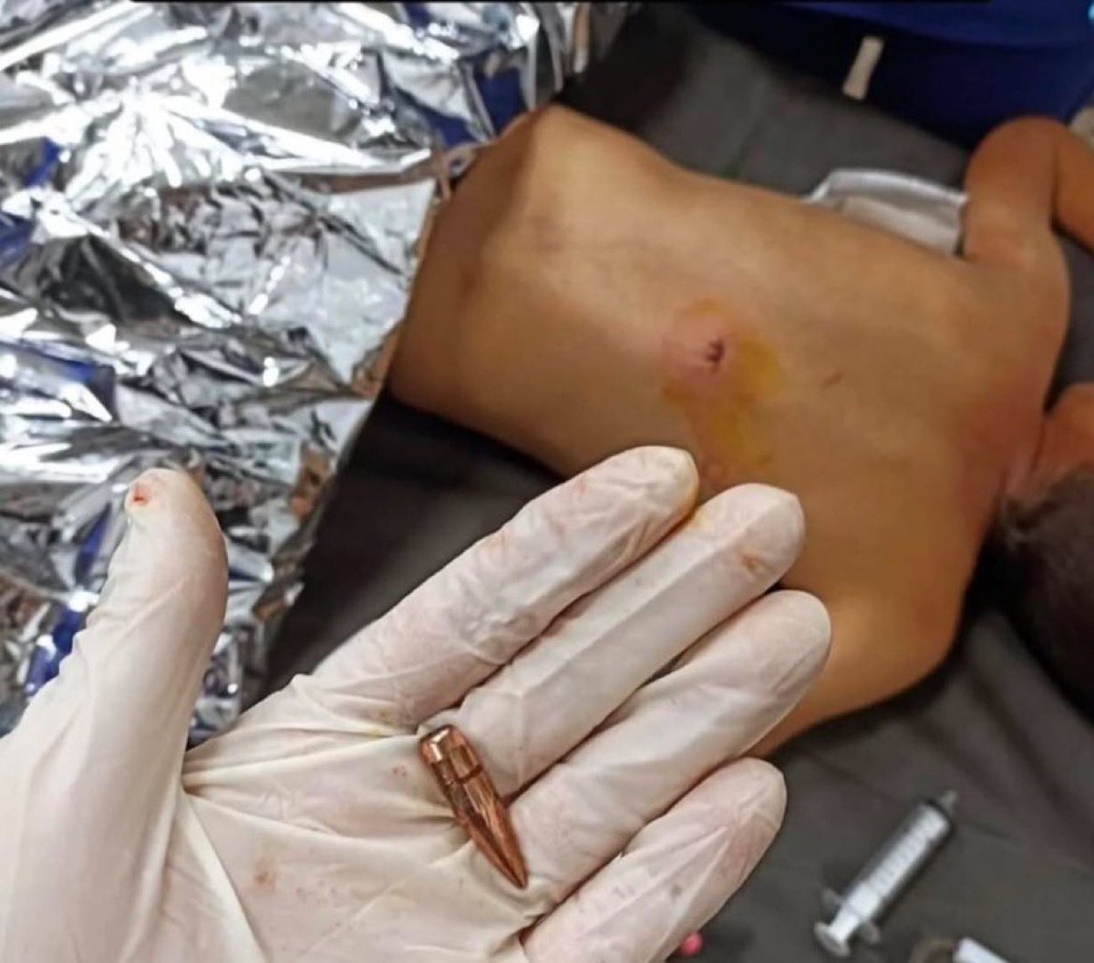 QudsNen's tweet image. This bullet, fired from an Israeli drone, was extracted from the back of a 7-year-old Palestinian child, causing him permanent paraplegia.