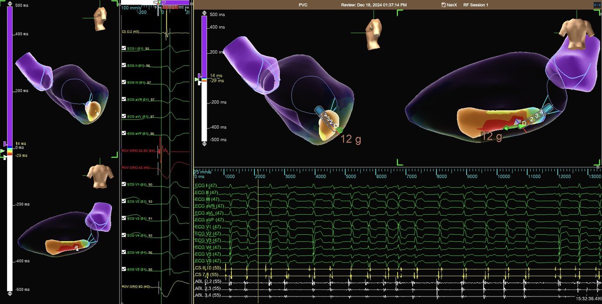 The notorious papillary muscle PVC. Originating from lateral aspect of the pap, these bigeminal PVCs were eliminated during the first RF session with the help of the tried and true PDX method. 

Link to publication:
pmc.ncbi.nlm.nih.gov/articles/PMC81…
