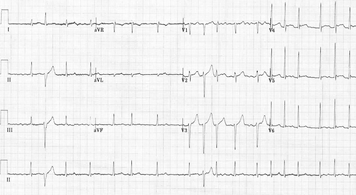 Ashman Phenomenon in #AtrialFibrillation:

The His-Purkinje system’s refractory period is proportional to the prior R-R interval. After a long R-R, a short R-R interval may trigger aberrant conduction (RBBB), as the system hasn't fully reset. 

As the refractory period of the