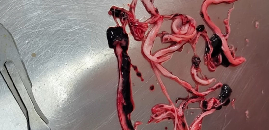 tmallard's tweet photo. The assassination was of who found 46 bioweapons labs in UKR complete with specific delivery drones capable of warefare

❄️ the #gain_of_function to discriminate Slavic DNA the goal 
🤷‍♂️
The result of #FearMongersForProfit, er, pharm'ah ?
=
These are #casts, #molds of pulked from arteries made by #antibodies binding a prior #spike to a new one on the #epithelial_layer [single-layer of arteries, veins], this of anyone having multiple jabs/shots/injections 
🤷‍♂️
A recent ppr found them in brains !
= strokes, sudden deaths while speaking, athletes global ?

#CrimesAgainstHumamity 
#InvoluntaryManslaughter 20yrs a count or #LifeNoParole ?
🤷‍♂️ 
1st public discourse, 49;19, https://t.co/QYaz721L77