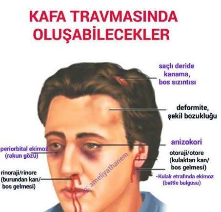 SirmaHande's tweet photo. @TCYargitay 3. Hukuk Dairesi'ne hatırlatarak, sormak istiyorum.

#EliniziVicdanınızaKoyun ve okuyun önce.

#Yargıtay 13. Hukuk Dairesi (3. H.D.nin eski adı) 23/03/2010 E. 2009/13214 K. 2010/3694.
Aynı yönde
👇
Yargıtay 13. H.D. 10/05/2018 E. 2015/41418 K. 2018/5670.

⭐️ Aydınlatılmış Onam yoksa, Bilirkişi Raporları aleyhte yazılmış olsa dahi KABUL EDİLEMEZ!

#Yargıtay 4. H.D. 07/03/1977 E. 76/6297 K. 77/2541.

Yargıtay 13. H.D. 18.09.2018 E. 2016/26894 K. 2018/8072

⭐️Kandırma yoluyla imzalatılan/matbu olarak imzalatılan Aydınlatılmış Onam geçersizdir ve davanın kabulünü gerektirir! 

#Yargıtay 13. H.D. 19.10.2006 E. 2006/10057 K. 2006/13842.

Bu ve benzeri kararlar, hep/çoğunlukla Yargıtay 3. Hukuk Dairesi (eski 13. H.D.) tarafından verilmiş ve içtihat olarak bizi destekler olmuşken, dava dosyamızdaki eksiklikleri tespit edemediniz mi #BattalYılmaz?

Bu ve benzeri kararlar, bir de sizin "Hekimin Hukuki Sorumluluğu" isimli kitabınızda da yer alırken?

Ne düşünmeliyim @tcbestepe @RTErdogan @adalet_bakanlik @yilmaztunc @TC_HSK @haksavdernegi @hhalilkoc @Hayati_Yazici @deryayanikashb?

Kanunlara, yönetmeliklere/sözleşmelere, bildirgelere ve içtihatlere göre, davamızın kabulü gerekirken, bize yaşatılanı açıklamanızı talep ediyorum.

Benim kızım, İstanbul Bahçelievler Medicalpark'ta SAKAT BIRAKILDI!
Doğduktan 4 gün sonra, beyninde sebebi bilinmeyen 3. evre (ileri derecede) bir kanama oluştu ve ne bana haber verildi, ne de tıbbi bir müdahalede bulunuldu!
1 ay kaldığı Yenidoğan Yoğun Bakım'da, taburculuk tarihinde, taburcu olmak koşuluyla, kandırma yoluyla, matbu bir Aydınlatılmış Onam Formu imzalatıldı eşime!
Kızımın kafasında ÇÖKME KIRIĞI var!
Epikrizinde ve raporlarında RESMİ EVRAKTA SAHTECİLİK SUÇU İŞLENDİ!

Açıklar mısınız bana?

Tüm bunlar ne anlama geliyor?

#YenidoğanÇetesi ni, #BebekKatilleri ni, #BebekCinayetleri ni ve özellikle kızımın SAKAT BIRAKILDIĞI İstanbul Bahçelievler #Medicalpark ı LANETLİYORUM!

#19Aralık
#Perşembe 

@emrullaherdinc @muratagirel @timursoykan @gtahincioglu @ComezTurhan