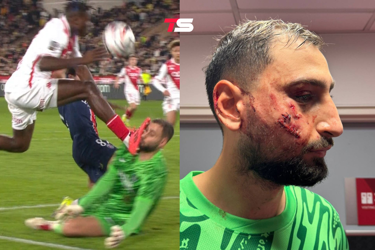 😮 Джанлуиджи Доннарумме досталось в матче с «Монако»: его заменили на 22-й минуте на Матвея Сафонова. А потом пришлось зашивать щеку.