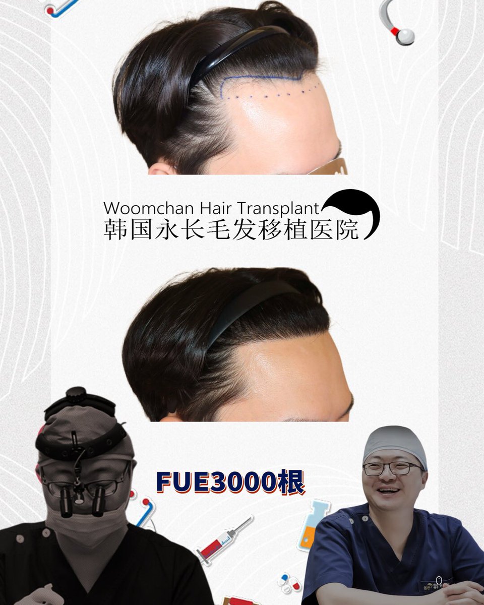 lee910907's tweet photo. FUE3000根加密髮際線
FUE3000 Hairs after 8months
 모발이식3000모 8개월 경과 
微信/  line👉woomchan
whatsapp: +821097895827
https://t.co/IWnWgwD2kc
 #韓國免剃髮植髮 #永長植髮 #woomchan永長植髮 #韩国植发医院 #韩国植髮費用 #hairtransplantsurgery #韓國免剃发植发 #FUE免剃发植 https://t.co/PrQ1uZwZL7