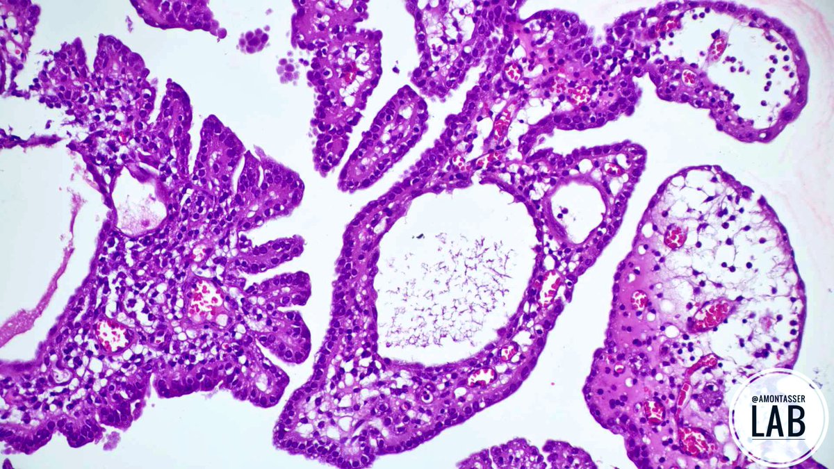 AMontasserMD's tweet photo. Urinary bladder Nephrogenic Adenoma 

#GUpath #PathX #Pathology