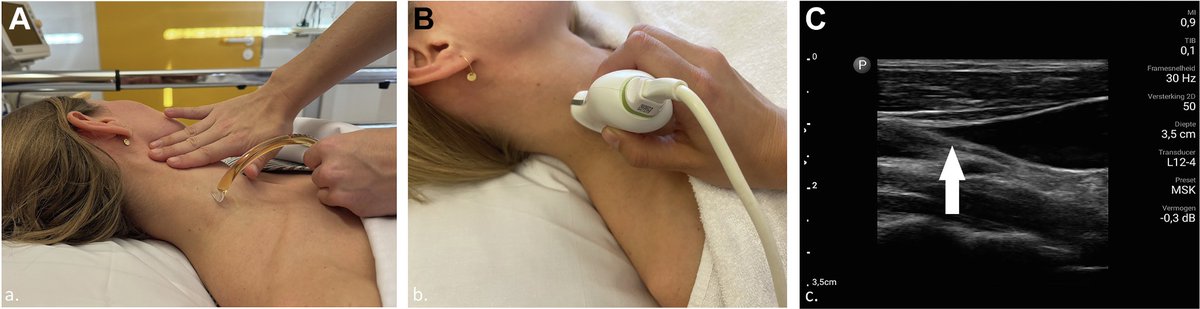 Central Venous Pressure in Hospitalized Patients – Accuracy of Physical Examination and #POCUS of the Jugular Vein and Inferior Vena Cava.
#FOAMed #FOAMcc 
🔗 chestcc.org/article/S2949-…