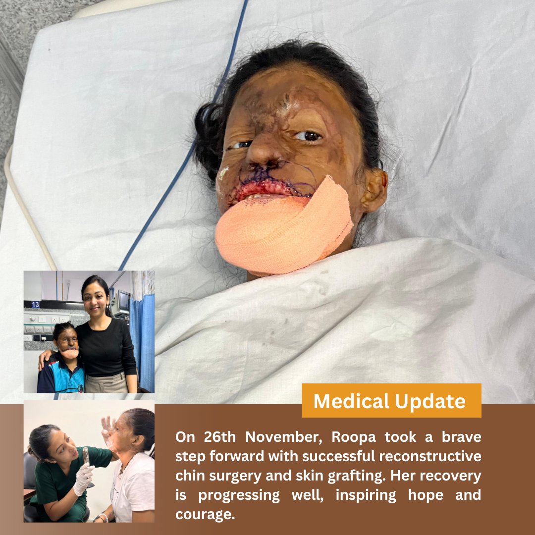Stop Acid Attacks (@stopacidattacks) on Twitter photo On 26th Nov, Roopa underwent successful chin reconstruction & skin grafting. Her recovery is going well, bringing hope & strength. Heartfelt gratitude to <a href="/aiims_newdelhi/">AIIMS, New Delhi 🇮🇳</a> & Shivangi maam for their compassion & support in empowering Team Sheroes.
#medicalupdate #stopacidattack On 26th Nov, Roopa underwent successful chin reconstruction & skin grafting. Her recovery is going well, bringing hope & strength. Heartfelt gratitude to <a href="/aiims_newdelhi/">AIIMS, New Delhi 🇮🇳</a> & Shivangi maam for their compassion & support in empowering Team Sheroes.
#medicalupdate #stopacidattack