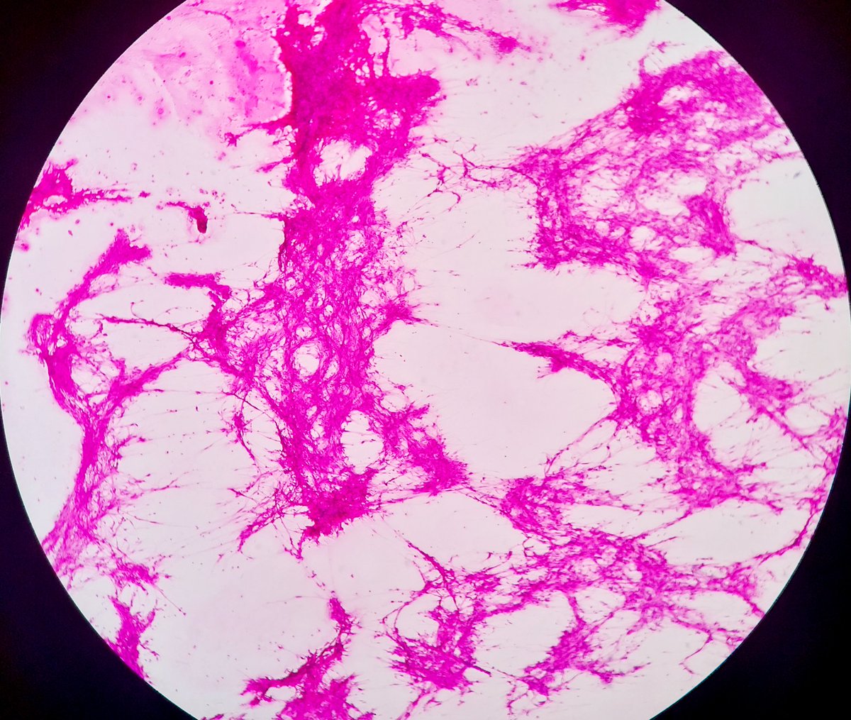 padmapathology1's tweet photo. #macropath #Grossognosis
#pathtwitter
Site - stomach
Diagnosis ⁉️
Clue - squash smears
#macromicrocorrelation https://t.co/0XB75I5heu