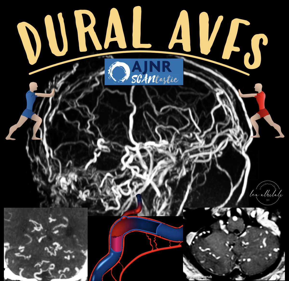 1/Talk about dangerous liaisons!

Abnormal brain vascular connections like a dural arteriovenous fistula (dural AVF) can be dangerous!

This month’s @theAJNR SCANtastic thread is here to you some durable knowledge about dural AVFs!

ajnr.org/content/45/12/…