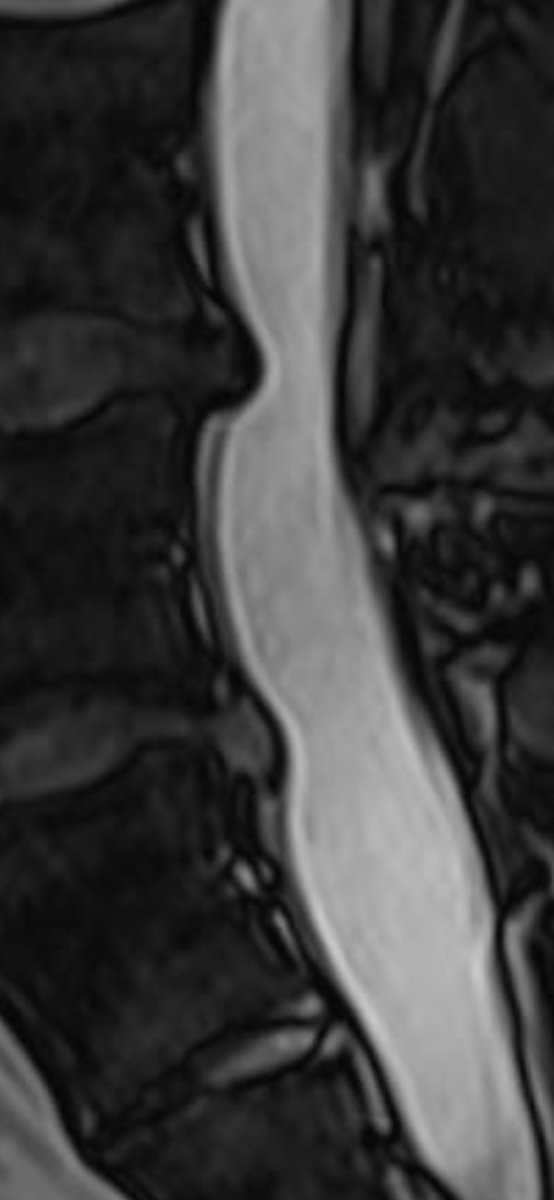 Welp, MRI shows both of my herniated discs are back after 3 years. Seems like my body wanted to give me an early Christmas gift