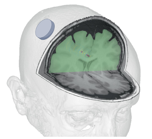 Noninvasive Ultrasound Lab (@wynnlegonlab) on Twitter photo Low-intensity focused ultrasound (LIFU) is a potentially transformative neuromodulation technique that offers millimeter precision and adjustable focal lengths to target small and deep human brain circuitry.
Read the full primer below on <a href="/MethodsPrimers/">Nature Reviews Methods Primers</a>:
go.nature.com/4iYbLnx Low-intensity focused ultrasound (LIFU) is a potentially transformative neuromodulation technique that offers millimeter precision and adjustable focal lengths to target small and deep human brain circuitry.
Read the full primer below on <a href="/MethodsPrimers/">Nature Reviews Methods Primers</a>:
go.nature.com/4iYbLnx