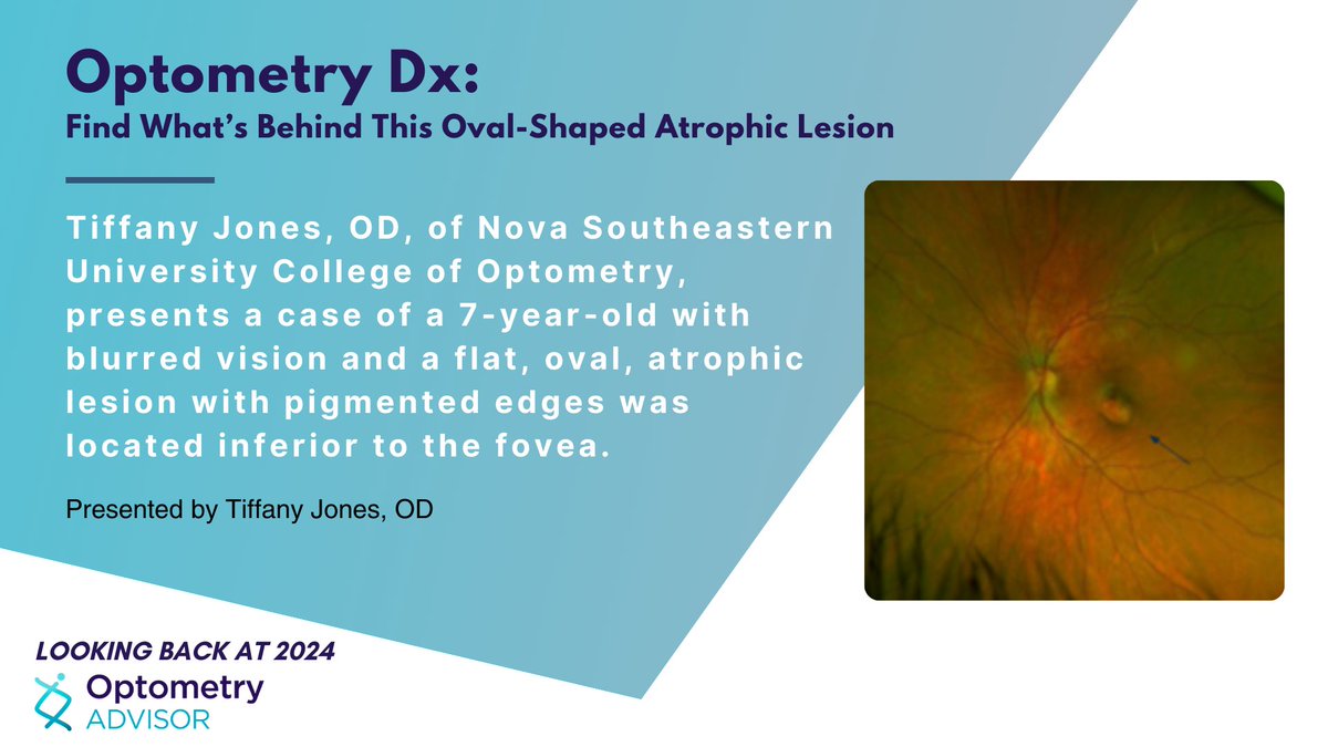 opto_advisor's tweet image. Optometry Dx: Find What’s Behind This Oval-Shaped Atrophic Lesion

Presented by Tiffany Jones OD of @NSUResearch — the case of a child with #BlurredVision and a flat, oval, #AtrophicLesion with pigmented edges located inferior to the #Fovea

Read here ➡️:  bit.ly/3ZRR6Kk