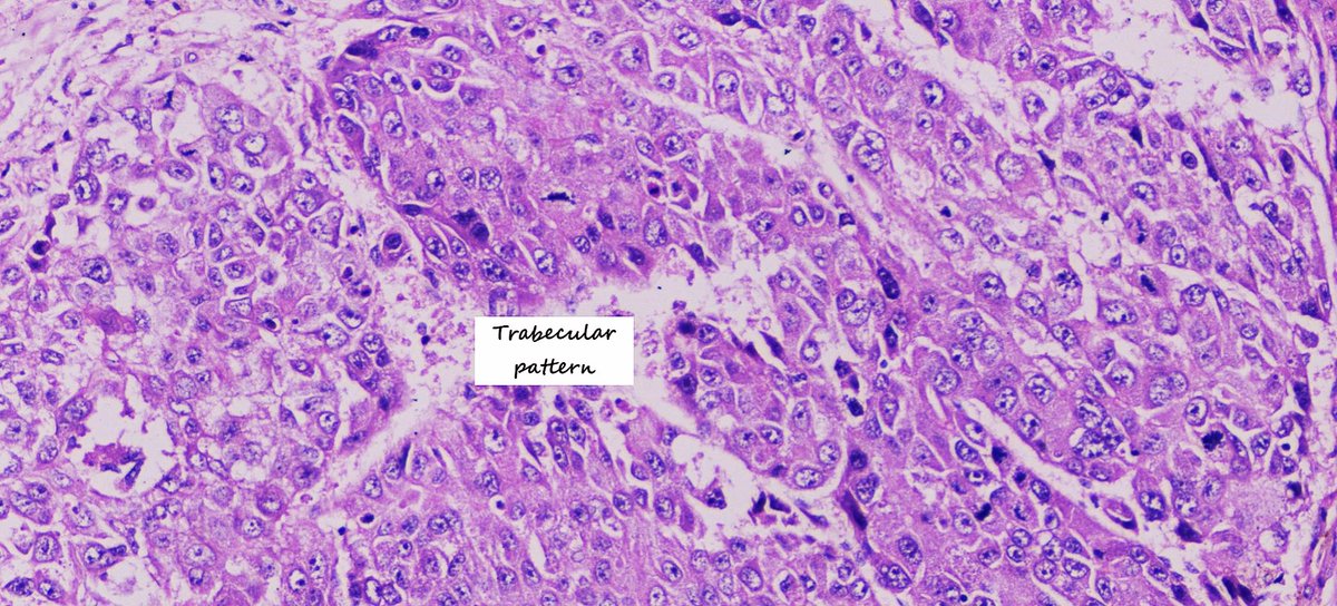 A 52 year male, known case of HBsAg positive for 15 years with progressively increasing mass in the liver.
#Pathology #Pathtwitter #Livercancer #Microscopy