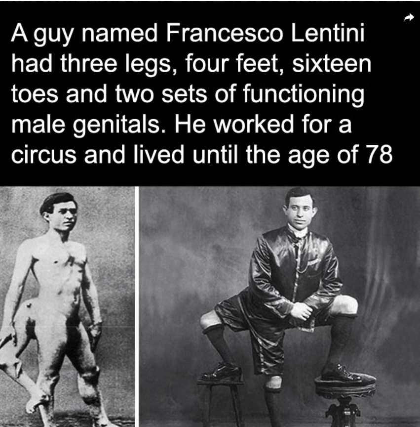 TCWTMedia's tweet image. 🦵👣 Terrifying Thursday Fact! 👣🦵

Francesco Lentini, born in 1889, was a man with three legs and four feet! 😱  Despite his unusual anatomy, Lentini lived a remarkable life as a performer in circuses, 🎪🌍
 #TerrifyingThursday #MedicalMarvels #FrancescoLentini
