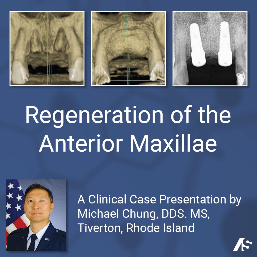 AceSouthern's tweet photo. 🙌  📑 Read about the successful regeneration of the anterior maxillae achieved using alloOss® particulate and the perFORM® Collagen Membrane now!: 

https://t.co/hH3VCGb9V5 https://t.co/3hcAWChxnZ