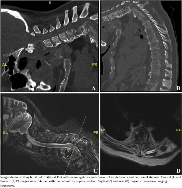 TheJNS's tweet photo. #JNSCaseLessons. Case of severe spinal deformity and myelopathy due to Multiple Myeloma successfully managed with preoperative gradual deformity realignment and external orthosis. https://t.co/JQKWpEpull https://t.co/I94W0d5g6L