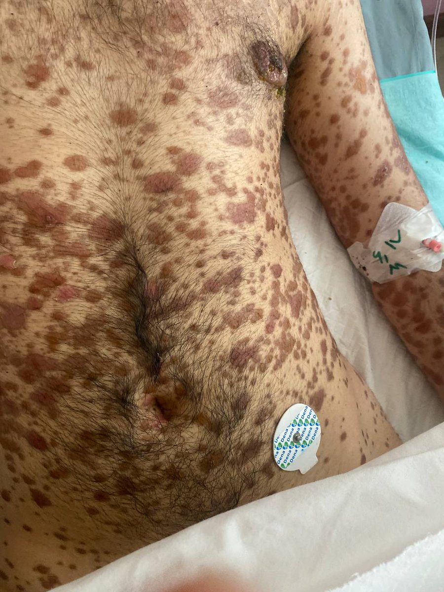 1ts_Mo's tweet photo. Med Quiz 🔴 
What is the diagnosis..........⁉️ https://t.co/LnvZxm9J9R