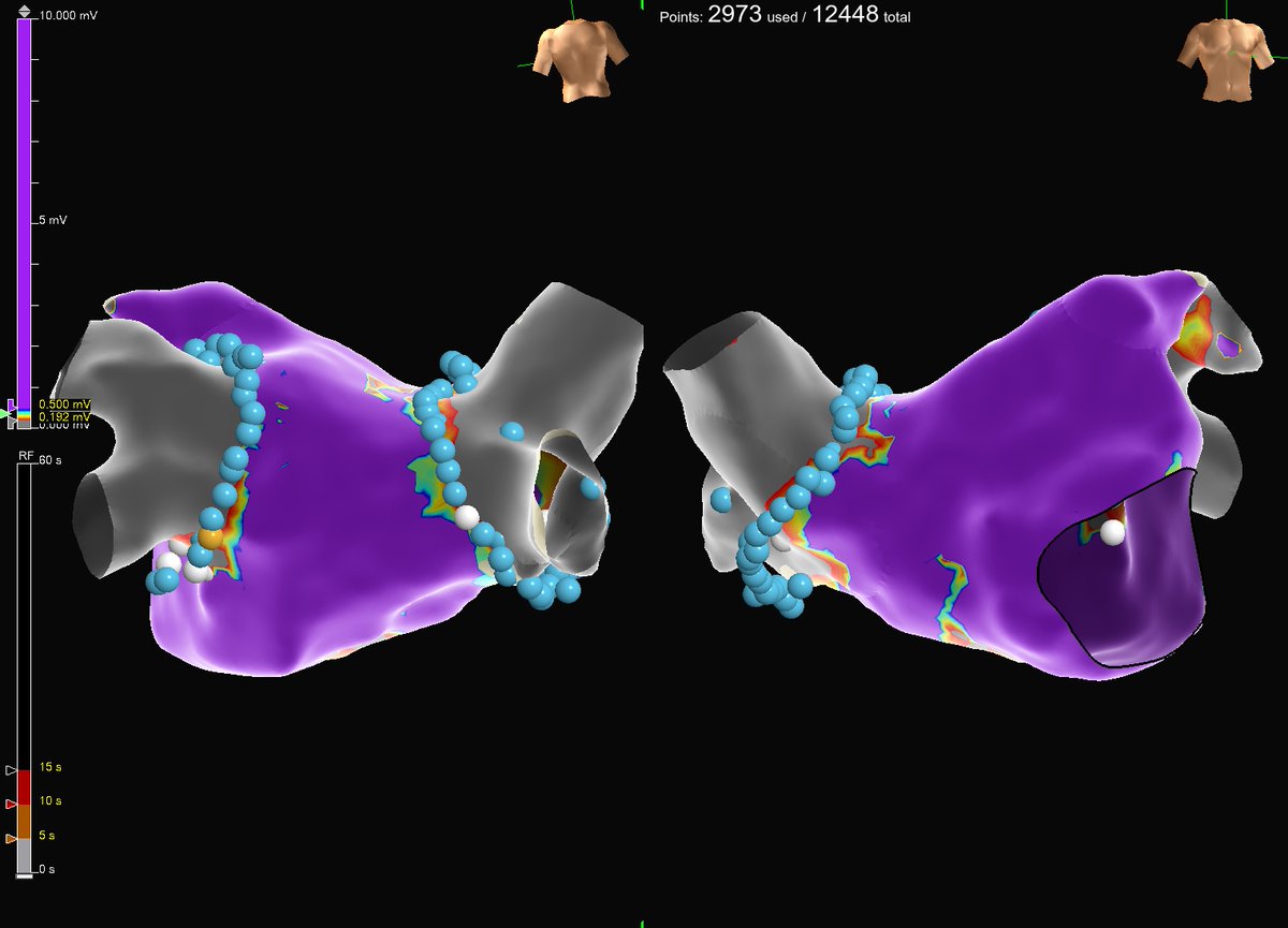 Mikael Laredo (@laredomikael) on Twitter photo 100% focal PFA pulmonary vein isolation perfomed as part of <a href="/AbbottCardio/">Abbott Cardiovascular</a> FOCALFLEX study.
Point-by-point ablation x PFA: the best of two worlds ! 100% focal PFA pulmonary vein isolation perfomed as part of <a href="/AbbottCardio/">Abbott Cardiovascular</a> FOCALFLEX study.
Point-by-point ablation x PFA: the best of two worlds !
