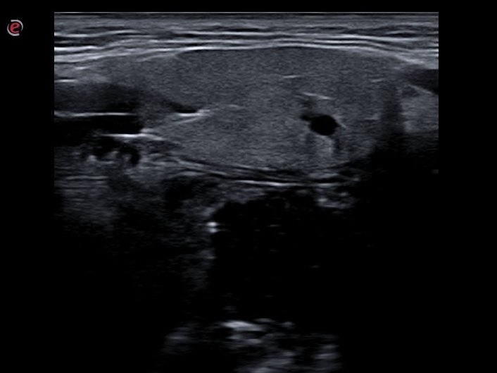 💥¿Te interesa la patología de Glándulas salivares? Aprovecha la oportunidad y matricúlate en nuestro curso online de ECO DE REGIÓN CERVICAL ANTERIOR en el campus de <a href="/somamfyc/">SoMaMFyC</a>  👉👉 precio especial para socios de somamfyc y semfyc!! Toda la info🔎somamfyc.com/mc-events/curs…
