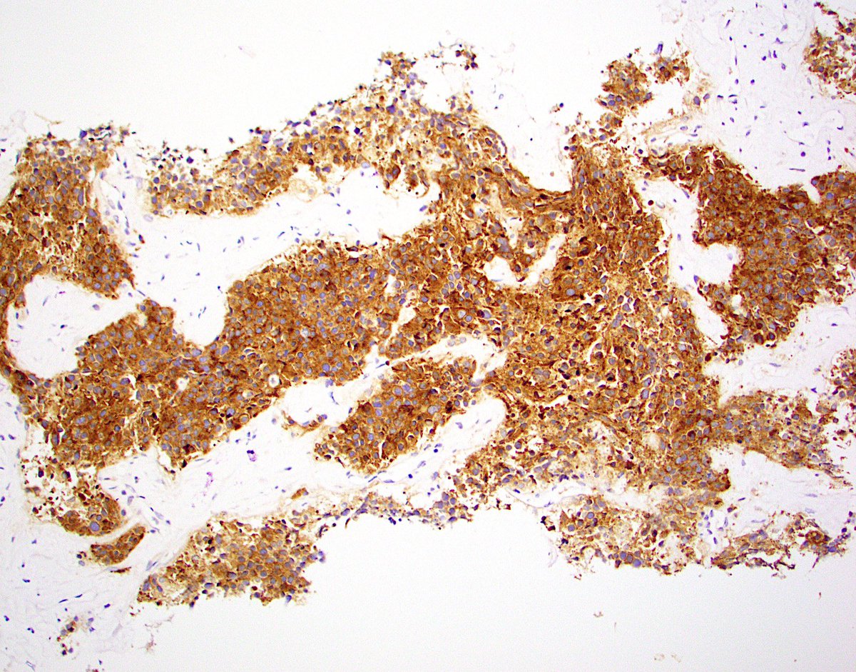 CuringCancerNetwork (@curingn) on Twitter photo Liver & intrahepatic bile ducts - What's your diagnosis?
Topic link: pathologyoutlines.com/topic/livertum…
Images contributed by Whayoung Lee, M.D.
Visit our CCN blog for cancer-related essays by Dr. Pernick: pathologyoutlines.com/ccnessays.html.
#Cancer #CancerResearch #CuringCancerNetwork #Pathology Liver & intrahepatic bile ducts - What's your diagnosis?
Topic link: pathologyoutlines.com/topic/livertum…
Images contributed by Whayoung Lee, M.D.
Visit our CCN blog for cancer-related essays by Dr. Pernick: pathologyoutlines.com/ccnessays.html.
#Cancer #CancerResearch #CuringCancerNetwork #Pathology
