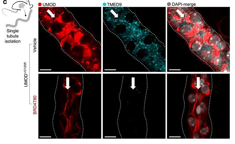 ASCI (@the_asci) on Twitter photo Flushing out misfolded uromodulin as a treatment concept for kidney proteinopathies: jci.org/articles/view/…
ASCI member <a href="/AnnaGreka/">Anna Greka</a> & team <a href="/harvardmed/">Harvard Medical School</a> restored uromodulin localization in models of autosomal dominant tubulointerstitial kidney disease using a TMED-targeting small Flushing out misfolded uromodulin as a treatment concept for kidney proteinopathies: jci.org/articles/view/…
ASCI member <a href="/AnnaGreka/">Anna Greka</a> & team <a href="/harvardmed/">Harvard Medical School</a> restored uromodulin localization in models of autosomal dominant tubulointerstitial kidney disease using a TMED-targeting small