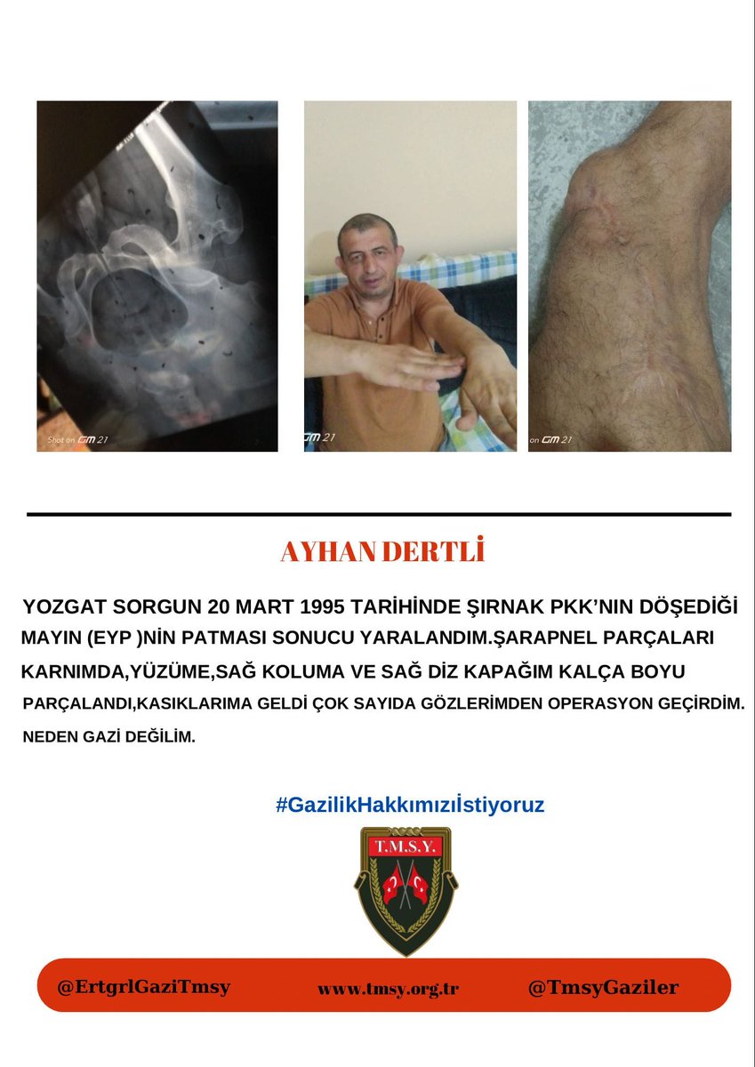 T.M.S.Y Selman Akbaş (@akbas_selm72417) on Twitter photo 🇹🇷MİLLET🇹🇷
KURŞUN YEDİK
ŞARAPNEL YEDİK
NEDEN GAZİ DEĞİLİZ
#GazilikHakkımızıİstiyoruz
<a href="/RTErdogan/">Recep Tayyip Erdoğan</a>
<a href="/cevdetyilmaz/">cevdetyılmaz</a>
<a href="/dbdevletbahceli/">Devlet Bahçeli</a>
<a href="/MahinurOzdemir/">Mahinur Özdemir Göktaş</a>
<a href="/drbetulsayan/">Dr.Betül Sayan Kaya 🇹🇷</a>
<a href="/avabdullahguler/">Abdullah Güler</a>
<a href="/FeyziBerdibek1/">Feyzi Berdibek🇹🇷</a>
<a href="/celebimehmeta/">Mehmet Ali Çelebi</a>
<a href="/MvDrHasanArslan/">Dr. Hasan Arslan</a>
<a href="/kocakkonuralp/">Konur Alp Koçak</a>
<a href="/SayimMadak/">Dr. Sevim Sayım Madak 🇹🇷</a>
<a href="/leventalyyildiz/">Levent Ali YILDIZ</a> <a href="/mhrmkurt/">Muharrem KURT</a> 🇹🇷MİLLET🇹🇷
KURŞUN YEDİK
ŞARAPNEL YEDİK
NEDEN GAZİ DEĞİLİZ
#GazilikHakkımızıİstiyoruz
<a href="/RTErdogan/">Recep Tayyip Erdoğan</a>
<a href="/cevdetyilmaz/">cevdetyılmaz</a>
<a href="/dbdevletbahceli/">Devlet Bahçeli</a>
<a href="/MahinurOzdemir/">Mahinur Özdemir Göktaş</a>
<a href="/drbetulsayan/">Dr.Betül Sayan Kaya 🇹🇷</a>
<a href="/avabdullahguler/">Abdullah Güler</a>
<a href="/FeyziBerdibek1/">Feyzi Berdibek🇹🇷</a>
<a href="/celebimehmeta/">Mehmet Ali Çelebi</a>
<a href="/MvDrHasanArslan/">Dr. Hasan Arslan</a>
<a href="/kocakkonuralp/">Konur Alp Koçak</a>
<a href="/SayimMadak/">Dr. Sevim Sayım Madak 🇹🇷</a>
<a href="/leventalyyildiz/">Levent Ali YILDIZ</a> <a href="/mhrmkurt/">Muharrem KURT</a>