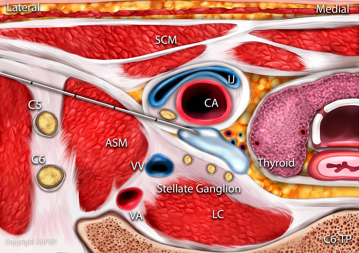 Stellate Ganglion BLOCK 💉💉
The ONLY block with the MOST medical indications😍
1. Post Traumatic Stress Disorder (PTSD)
2. Long COVID
3. Facial Pain
4. Complex Regional Pain Syndrome (CRPS)
5.Acute Limb Ischemia
6. Ventricular Tachycardia (Electrical Storm)
7. Tinnitus
8.