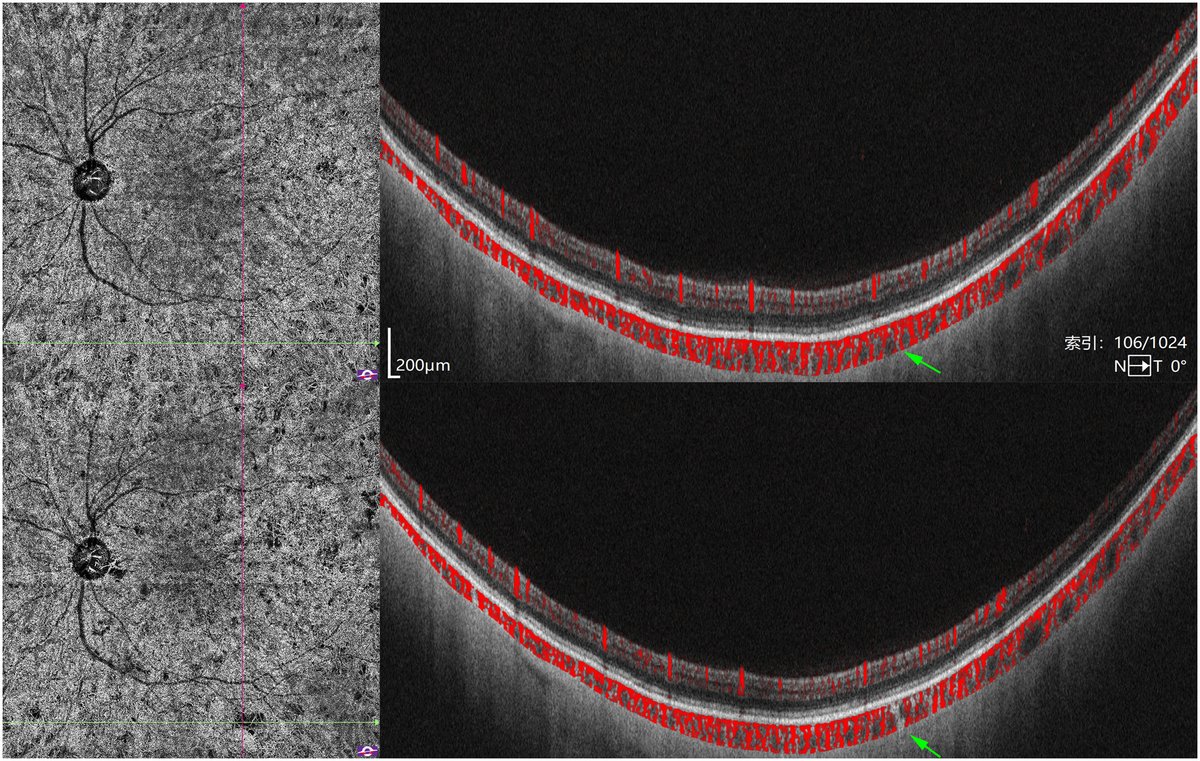 Decreased choriocapillaris vessel density in the ipsilateral eye after carotid artery revascularization detected by widefield SS-OCTA.
ow.ly/NOJ350U5CC0
#ophthalmology