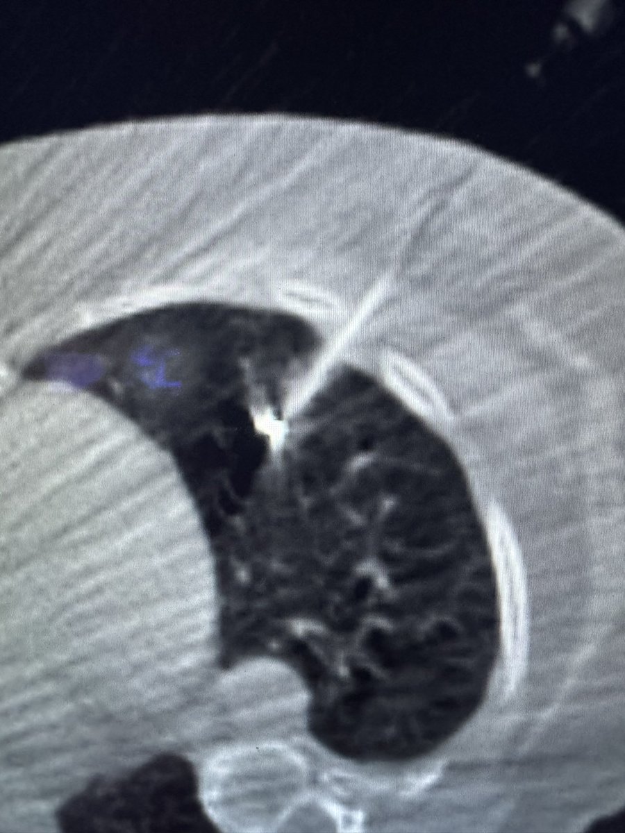 JMammarappallil's tweet image. #radres ! Look at this amazing case that you can do when you do fellowship @DukeRadiology @DukeRadCTI ! Tiny nodule preop for resection. @DukeCTSurgery needed localization. ICG soaked coil placed. Thanks @vigneshramanmd for the 📸! @atscommunity @DukeIR @accpchest @RSNA 🫁☝🏽