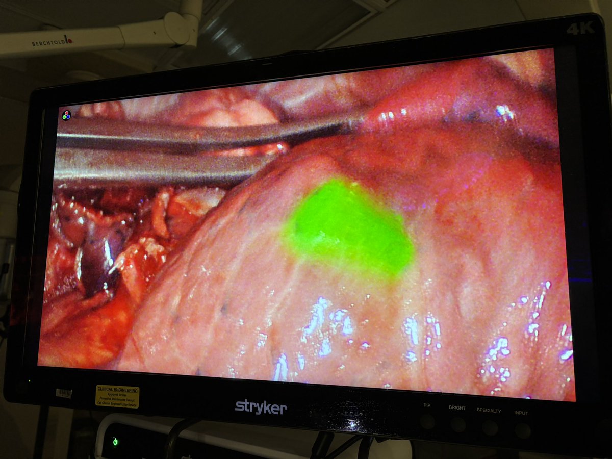Joe Mammarappallil (@jmammarappallil) on Twitter photo #radres ! Look at this amazing case that you can do when you do fellowship <a href="/DukeRadiology/">Duke Radiology</a> <a href="/DukeRadCTI/">DukeCTI</a> ! Tiny nodule preop for resection. <a href="/DukeCTSurgery/">DukeCTSurgery</a> needed localization. ICG soaked coil placed. Thanks @vigneshramanmd for the 📸! <a href="/atscommunity/">American Thoracic Society (ATS)</a> <a href="/DukeIR/">Duke IR</a> <a href="/accpchest/">CHEST</a> <a href="/RSNA/">RSNA</a> 🫁☝🏽 #radres ! Look at this amazing case that you can do when you do fellowship <a href="/DukeRadiology/">Duke Radiology</a> <a href="/DukeRadCTI/">DukeCTI</a> ! Tiny nodule preop for resection. <a href="/DukeCTSurgery/">DukeCTSurgery</a> needed localization. ICG soaked coil placed. Thanks @vigneshramanmd for the 📸! <a href="/atscommunity/">American Thoracic Society (ATS)</a> <a href="/DukeIR/">Duke IR</a> <a href="/accpchest/">CHEST</a> <a href="/RSNA/">RSNA</a> 🫁☝🏽