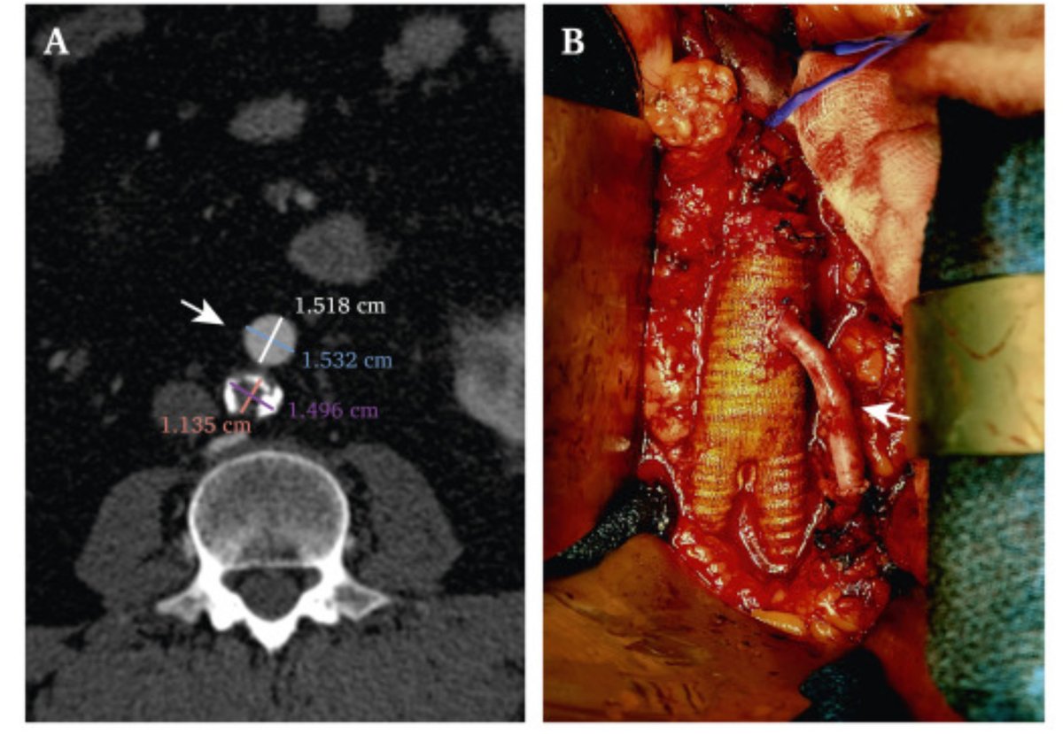When the IMA is larger than the occluded aorta 
a <a href="/EJVES_ESVS/">EJVES</a> « coup d’oeil » from <a href="/CHUBordeaux/">CHU de Bordeaux</a>  OR  by  our 🇮🇹resident Marco Campolmi An Inferior Mesenteric Artery Too Good To Go sciencedirect.com/science/articl… #aortaEd