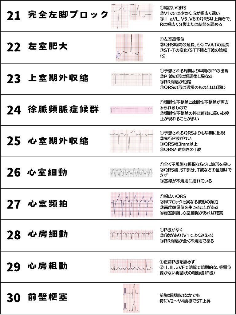 ecgkuma's tweet photo. 基本的な心電図の名称、波形、特徴を表に40選まとめました！ https://t.co/aaXsJDd1gs