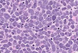 Andrea Apolo, M.D. (@apolo_andrea) on Twitter photo We have several accruing #ClinicalTrials for patients with #SmallCell #BladderCancer
1. #Lurbi +/- #Avelumab LASER
clinicaltrials.gov/study/NCT06228…
2. #SG +/- #Atezo SMART
clinicaltrials.gov/study/NCT06161…
3. #CaboNivoIpi ICONIC
clinicaltrials.gov/study/NCT03866… ncimo_referrals@mail.nih.gov / ☎️240-760-6006 We have several accruing #ClinicalTrials for patients with #SmallCell #BladderCancer
1. #Lurbi +/- #Avelumab LASER
clinicaltrials.gov/study/NCT06228…
2. #SG +/- #Atezo SMART
clinicaltrials.gov/study/NCT06161…
3. #CaboNivoIpi ICONIC
clinicaltrials.gov/study/NCT03866… ncimo_referrals@mail.nih.gov / ☎️240-760-6006