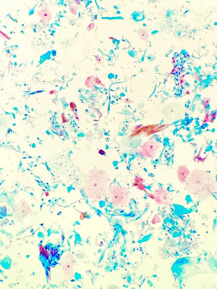 Gloria_SuraMD's tweet photo. Cystoscopy showed a large ulcerating mass in the bladder. Urine cytology is pictured. What is the diagnosis? Answer: https://t.co/3krNEl5r99 #CytoPath #PathTwitter #MedTwitter #PathArt https://t.co/ZUeBFQq6Oa https://t.co/1Z9ST015qk