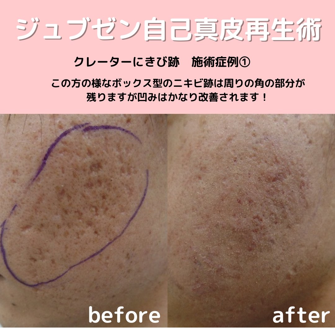 クレーターニキビ跡にお悩みの方💡 オンラインカウンセリングの際