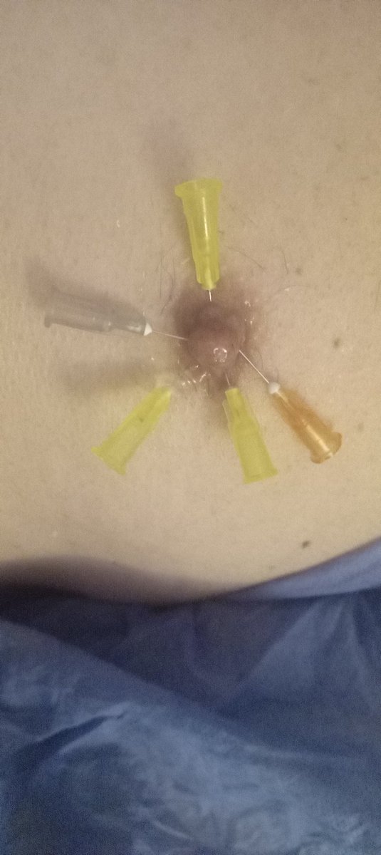 CarolDominatrix's tweet photo. #Femocracy 
#FemocracySpain Ultima Sesion Sadomedical de 2024
#Femdom
#needleplay #nipleplay #sounding #torture #bdsm https://t.co/wLrR8K0dLW