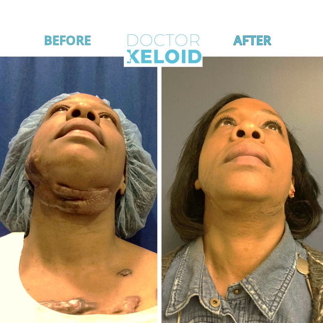 Get the BEST #KeloidCare you need! WE ACCEPT INSURANCE — United, Signa, Blue Cross, Aetna, 1199 etc.
Book your virtual consultation now! #drkeloid
