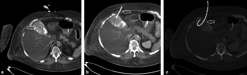I am reading thieme-connect.com/products/ejour…

#irad #radtwitter #radiology #MedTwitter