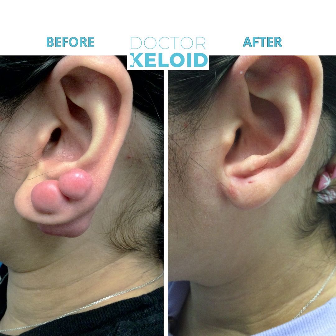 Get the BEST #KeloidCare you need! ✨ WE ACCEPT INSURANCE — United, Signa, Blue Cross, Aetna, 1199 etc. 
Book your virtual consultation now! #DrKeloid