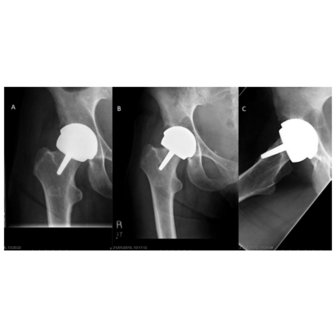 Hip resurfacing arthroplasty demonstrates excellent long-term survival if the the size of the femoral component is 48 mm or larger.

#BJO #Arthroplasty #Surgery <a href="/bonesmith_/">Haseeb Gani</a>

ow.ly/O60b50UsGMx