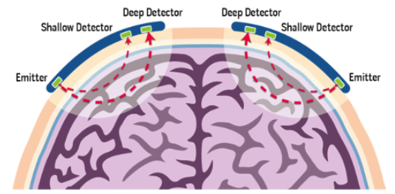wfsaorg's tweet photo. 🆕 Last tutorial of the year - ATOTW 538:  Cerebral Oximetry—An Introduction https://t.co/brMo7ctVOP

This tutorial provides a concise overview of cerebral oximetry, focusing on the basic science of near-infrared spectrometry, its limitations, primary applications, and its use in various surgical procedures. #anaesthesia #anesthesiology #cerebraloximetry
